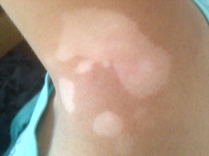 武汉有特效药治疗白癜风吗