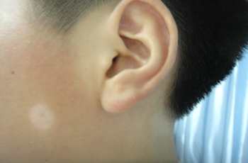 武汉儿童白癜风怎么治疗