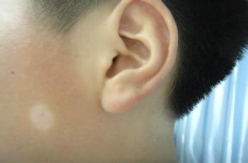 武汉孩子白癜风早期该如何治愈