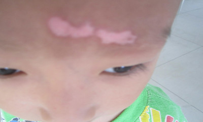 武汉白癜风初期如何治疗比较好 武汉宝宝得了白癜风怎么办