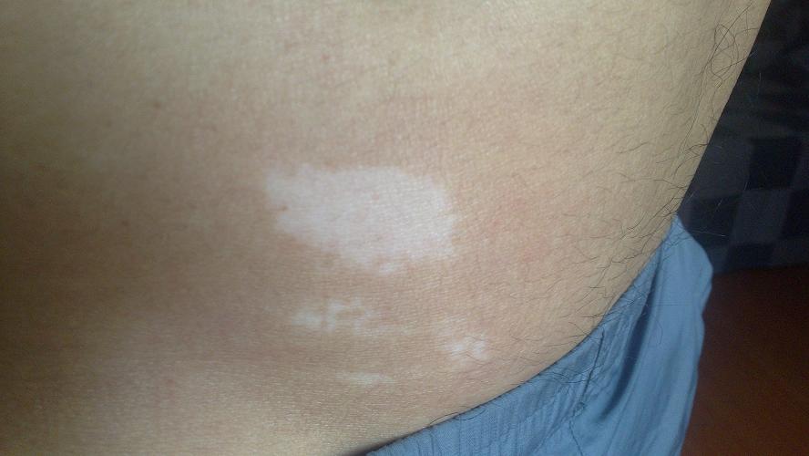 武汉详细解析白癜风早期如何治愈 武汉一般来说白癜风多久能治愈呢