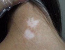 武汉日常生活中白癜风能不能治愈呢 武汉日常生活中白癜风能不能治愈呢