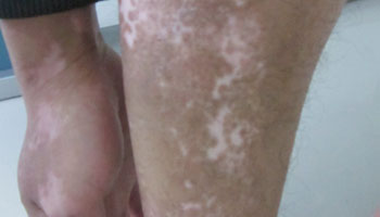 武汉白癜风的症状及治疗到底是什么 武汉白癜风的症状和治疗是什么