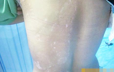 武汉白癜风医院找哪家 武汉白癜风正规的治疗方式