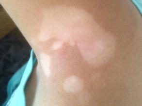 武汉白癜风治疗的方法 武汉白癜风可以治的好吗